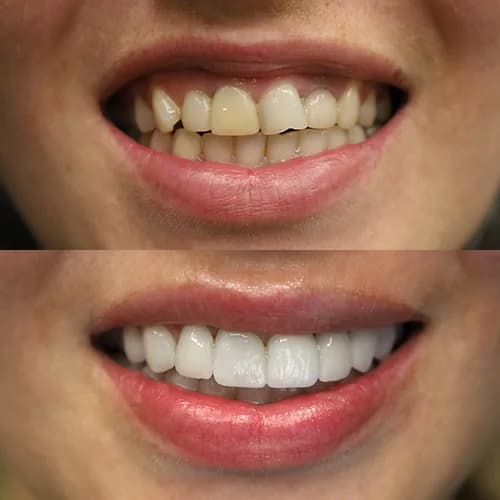 before_after_works.full_mouth_zirconium_2