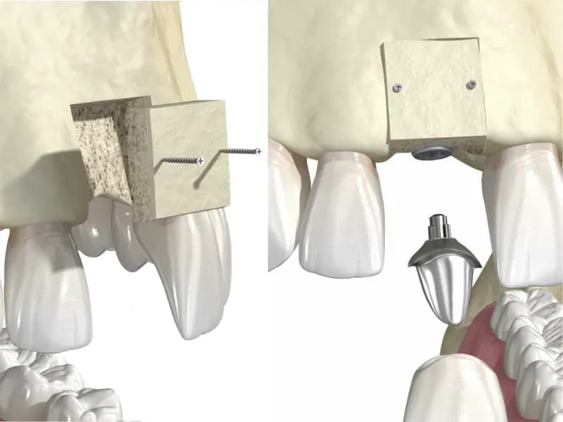 Bone Block Grafting