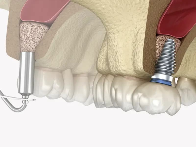 Close Sinus Lifting Image