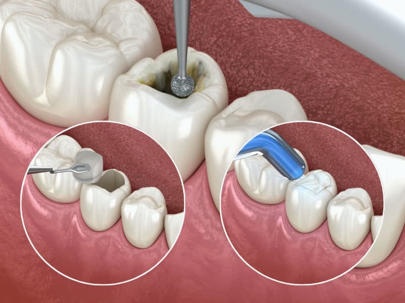 Dental Filling Image