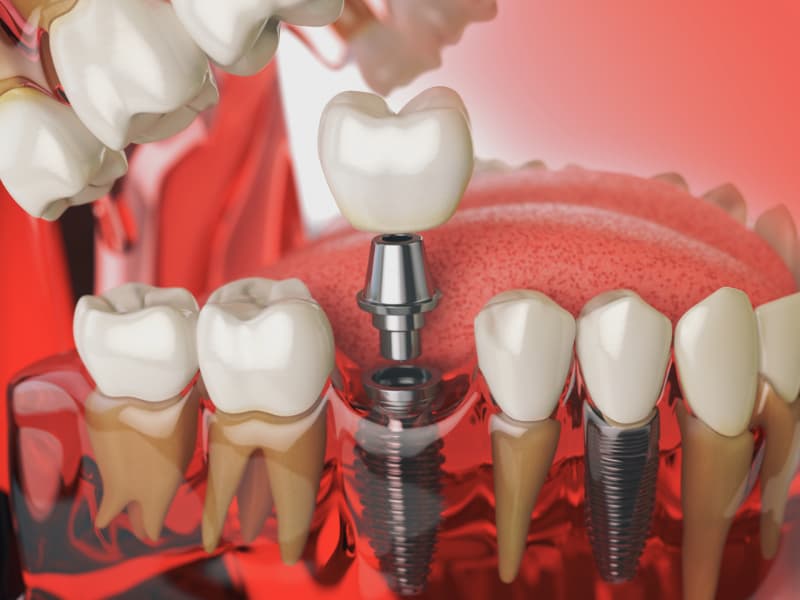 Dental Implants