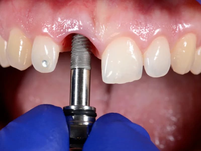 Implant Removal Image