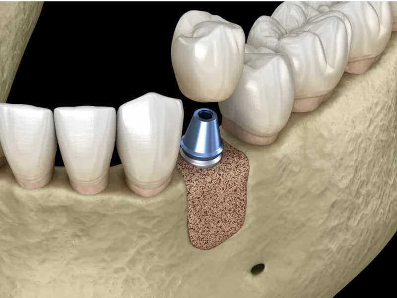 Membrane Treatment