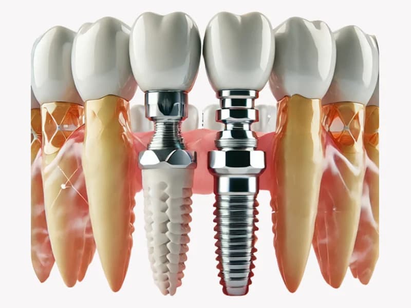 Multi-Unit Abutment For Dental Implants