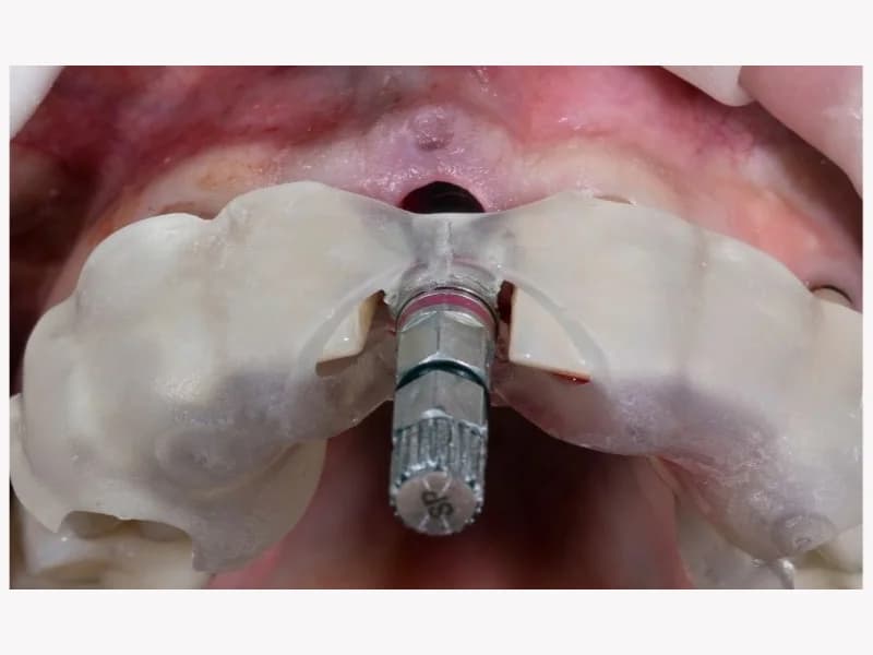 Non- Surgical Implant Image