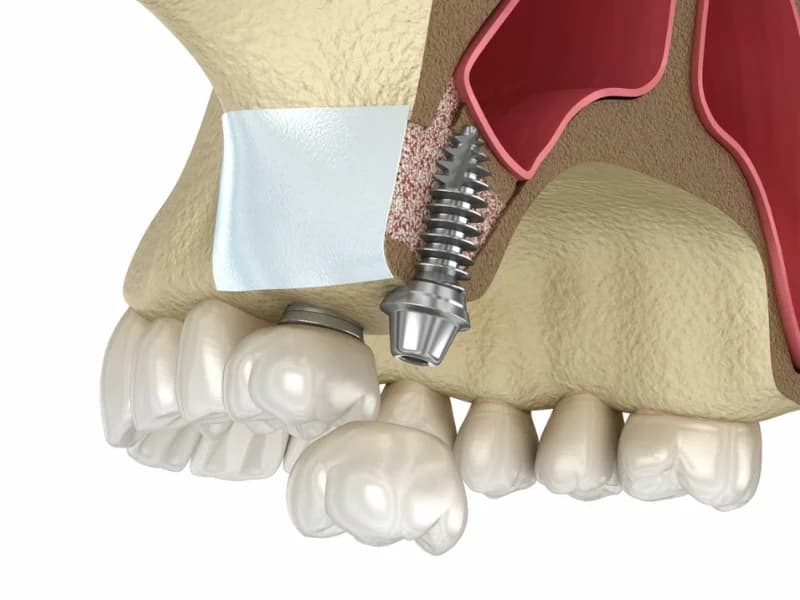 Open Sinus Lifting