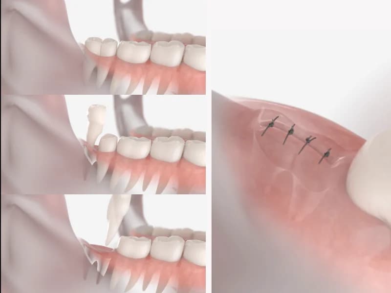 Surgical Tooth Extraction