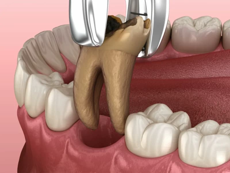 Tooth Extraction