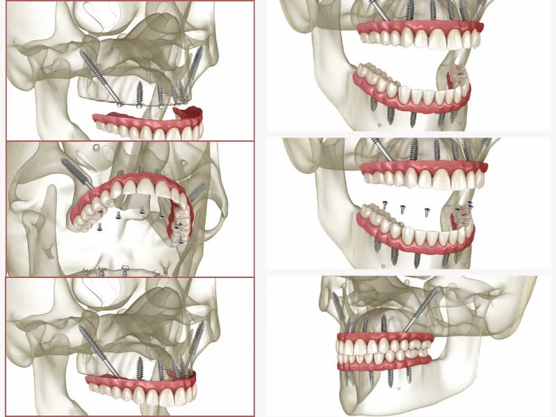 Zygomatic, Pterygoid And Nasal Implants