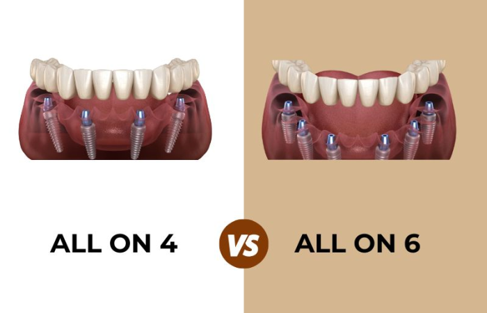 all on four or all on six dental implants turkey