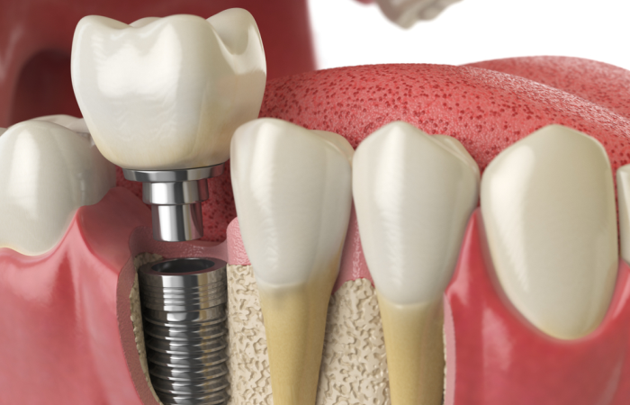 dental implants turkey