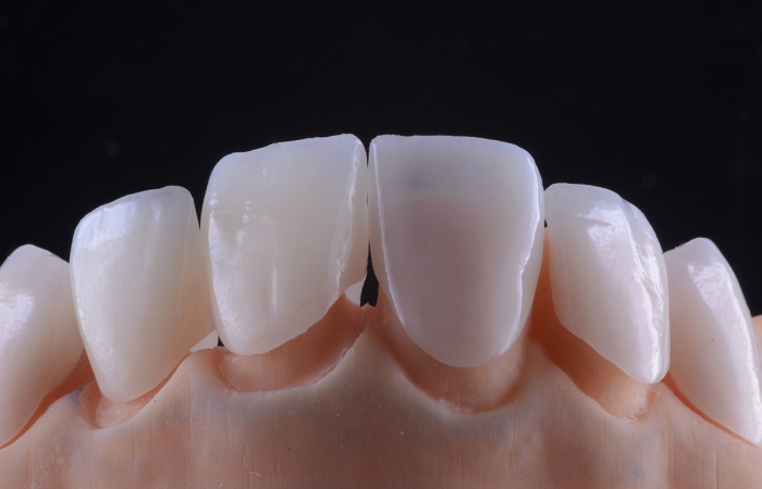 e max crowns in turkey
