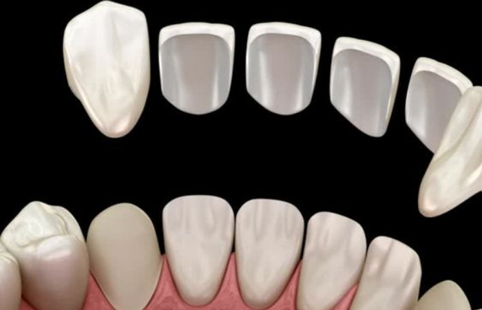 e max laminate veneers turkey