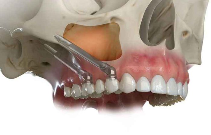 zygoma implant