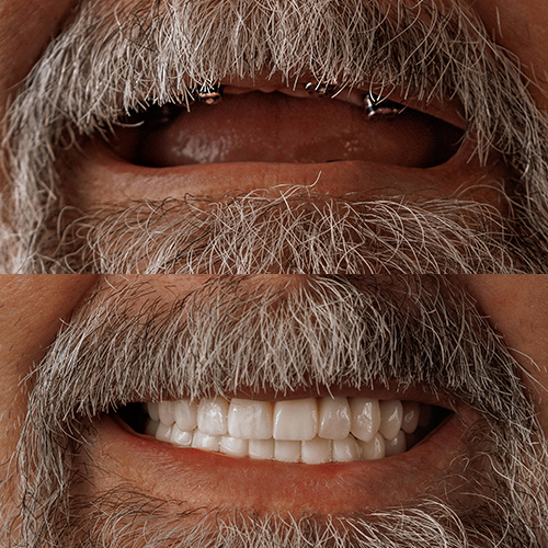 before_after_works.dental_implant