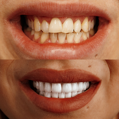 before_after_works.full_mouth_zirconium_3