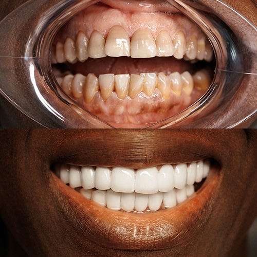 before_after_works.full_mouth_zirconium