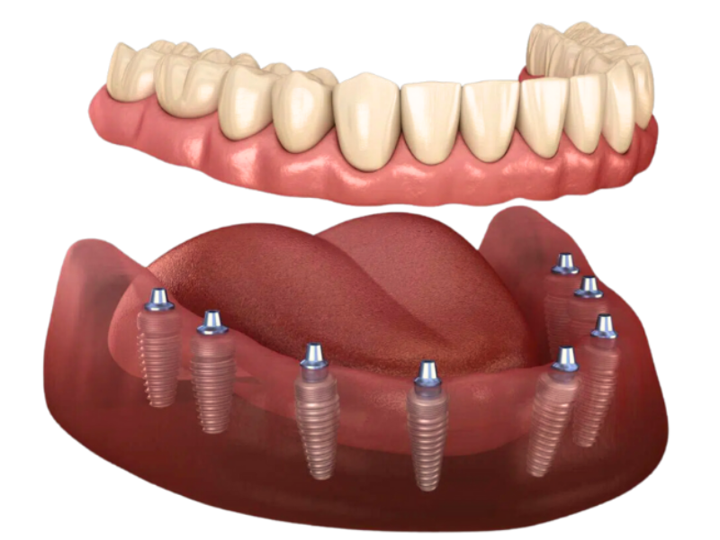 All On 8 Имплантаты